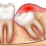 Pericoronarite: Quando a Extração Dentária se Torna Necessária